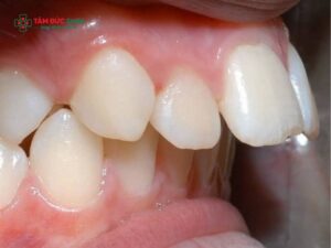 Trai răng hô trong tướng số nói lên điều gì? Phương pháp khắc phục răng hô cho nam giới hiện nay