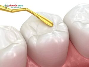 Abc8 Abcvip link không chặn mất bao lâu? Thời gian trám răng, trám răng sâu mất bao nhiêu phút