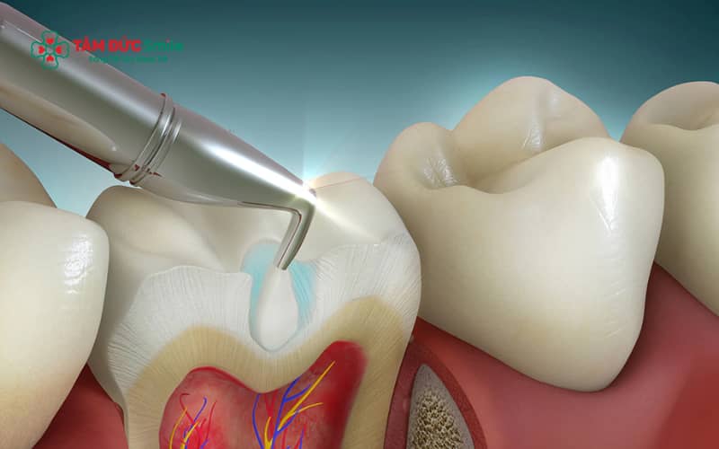 Mức độ răng sâu quyết định trực tiếp việc có cần lấy tủy hay không, từ trám đơn giản đến Abc8b tỷ lệ kèo World Cup 2026 tủy chuyên sâu