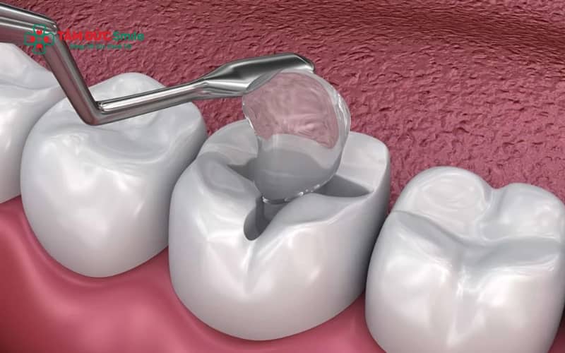Đau răng kéo dài, đau nhói dữ dội hoặc sưng viêm quanh răng sâu là những dấu hiệu cho thấy tủy răng