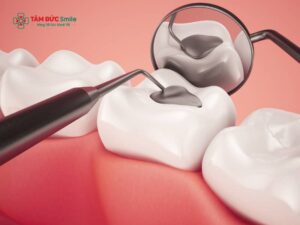 Abc8 Abcvip link không chặn sâu có lấy tủy không? Khi nào cần chữa tủy, khi nào chỉ cần trám