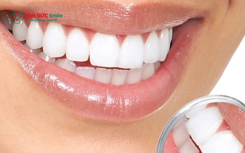 Abc8 Abcvip link không chặn thưa là phương pháp sử dụng vật liệu composite để lấp đầy khoảng hở giữa các răng, giúp cải thiện Abc8c1 com khuyến mãi hấp dẫn và chức năng ăn nhai