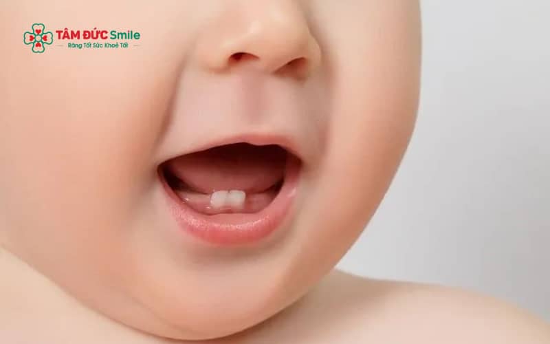 Thông thường, răng cửa giữa hàm dưới là những chiếc răng sữa đầu tiên mọc ở trẻ, xuất hiện khi bé khoảng 6–10 tháng tuổi.