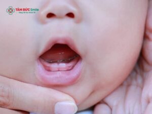 Trẻ mọc răng nào trước? Thứ tự mọc răng sữa & dấu hiệu ba mẹ cần biết