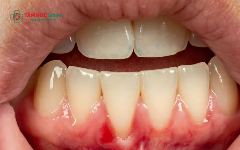 Tụt nướu răng là tình trạng mô nướu co rút, làm lộ Abc8com giaitri tructuyen và khiến răng trông dài hơn so với bình thường