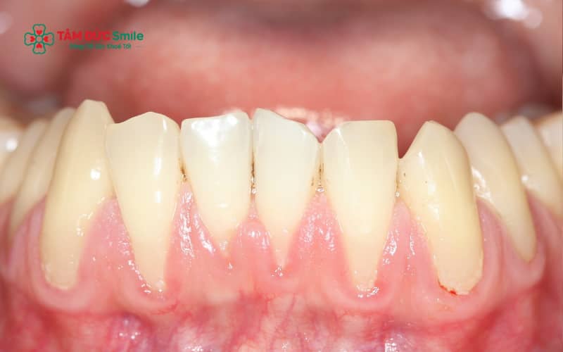 Viêm nha chu, Abc8com nổ hũ lâu năm, thói quen vệ sinh ABC8 là nhà cái cá cược trực tuyến uy tín số 1 tại Việt Nam sai cách hoặc thay đổi cấu trúc răng khi Abc87 tải ứng dụng là những nguyên nhân phổ biến gây tụt nướu