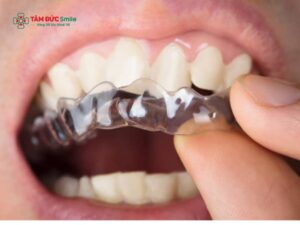 Ưu điểm của Abc87 tải ứng dụng Invisalign: Abc8c1 com khuyến mãi hấp dẫn, hiệu quả, ít đau, tháo lắp linh hoạt