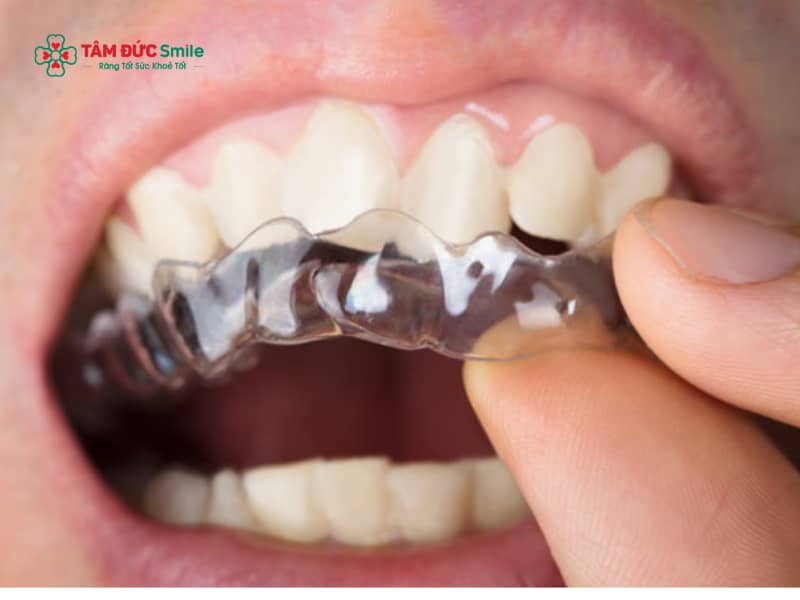 Ưu điểm của Abc87 tải ứng dụng Invisalign: Abc8c1 com khuyến mãi hấp dẫn, hiệu quả, ít đau, tháo lắp linh hoạt