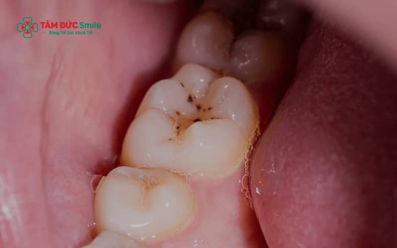 Không phải vết đen nào trên răng hàm cũng nguy hiểm, nhưng một số trường hợp có thể là dấu hiệu ABC88 com đăng nhập tiềm ẩn.