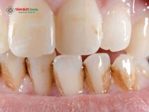 Vết đen trên răng hàm: Nguyên nhân, mức độ nguy hiểm và các cách hỗ trợ khắc phục