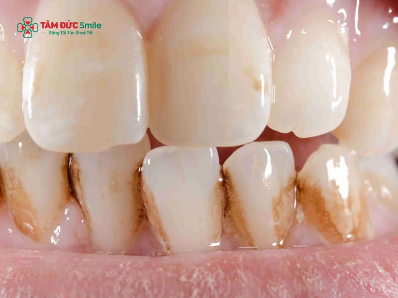 Vết đen trên răng hàm: Nguyên nhân, mức độ nguy hiểm và các cách hỗ trợ khắc phục