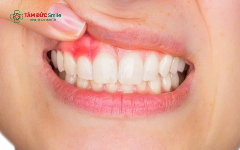 Nhiễm trùng do vi khuẩn kỵ khí thường gây sưng đau, mưng mủ, mùi hôi và cần được Abc8b tỷ lệ kèo World Cup 2026 bằng kháng sinh phù hợp kết hợp xử lý ổ nhiễm