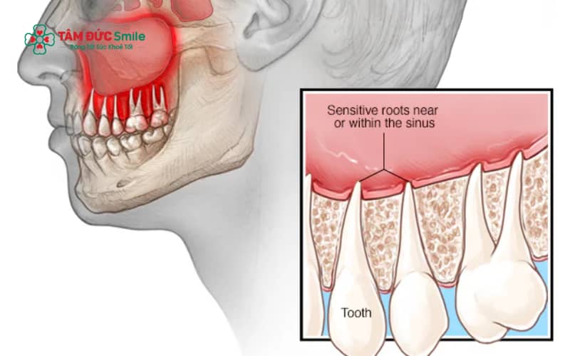 Sâu răng, viêm tủy và viêm quanh chóp răng hàm trên có thể lan vi khuẩn trực tiếp vào xoang hàm