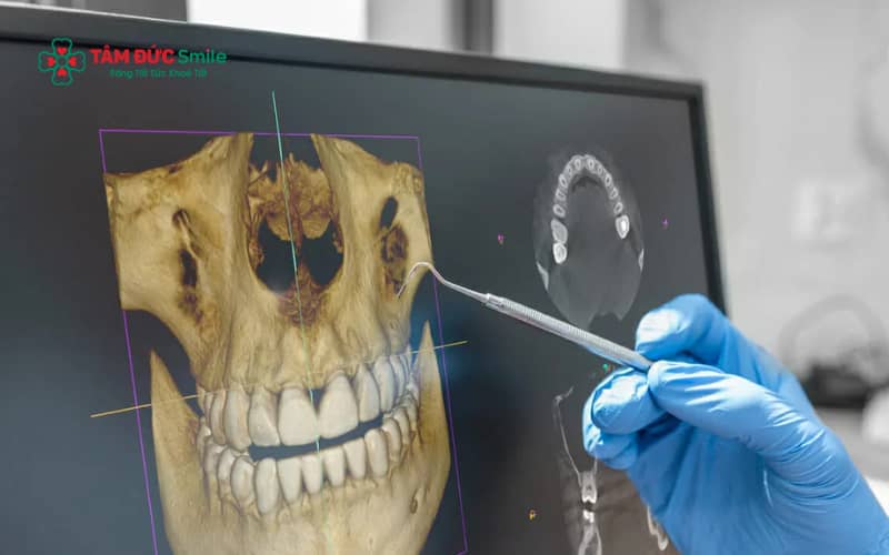Mối liên hệ giải phẫu giữa răng hàm trên và xoang hàm là nguyên nhân khiến bệnh lý răng có thể gây viêm xoang.