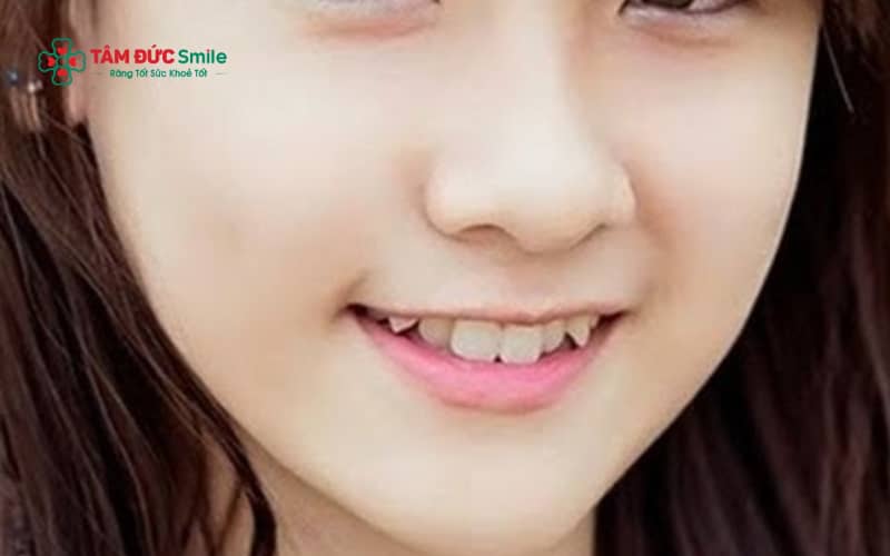 Răng hổ được đánh giá tốt khi có hình dáng cân đối, nhô vừa phải; ngược lại, răng quá dài, sắc nhọn hoặc lệch nhiều thường bị xem là răng hổ xấu