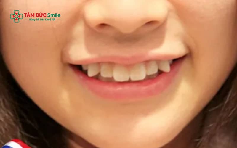 Răng hổ là chiếc răng nanh hơi nhô ra phía trước, thường được xem xét trong nhân tướng học để luận về tính cách, vận mệnh và sức hút cá nhân