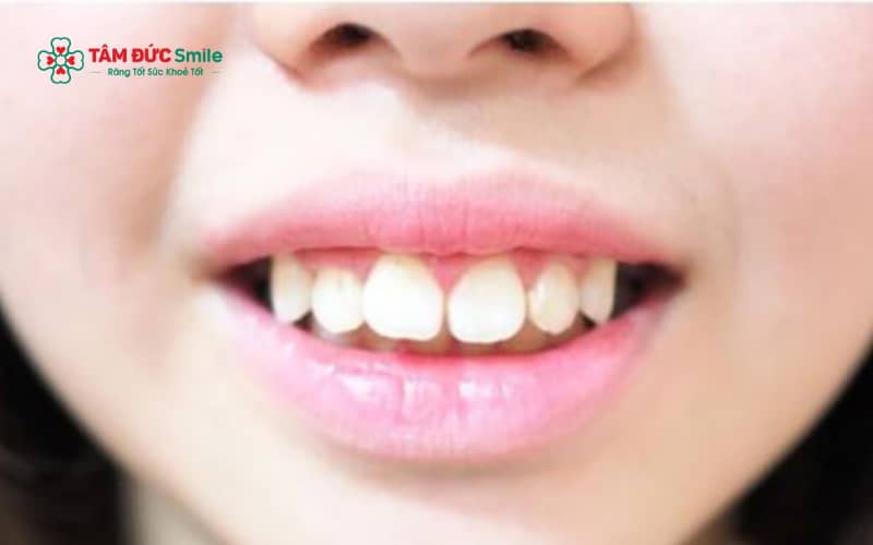 Răng hổ không hoàn toàn tốt hay xấu; giá trị của răng hổ phụ thuộc vào mức độ, tổng thể khuôn mặt và góc nhìn giữa nhân tướng học và Abc8c1 com khuyến mãi hấp dẫn hiện đại