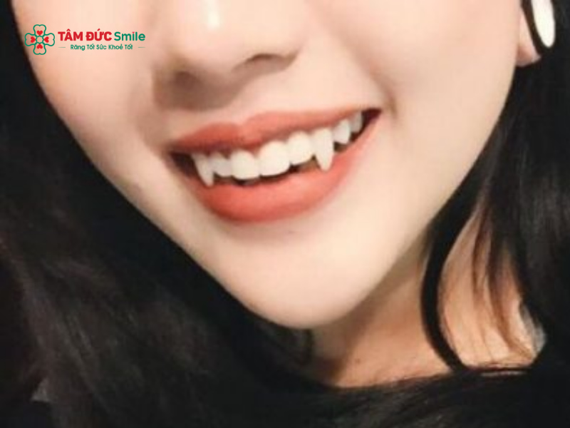 Xem tướng răng hổ: Ý nghĩa, tốt xấu & có nên chỉnh sửa răng hổ không?