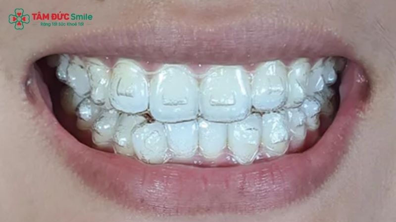 attachment-invisalign-1