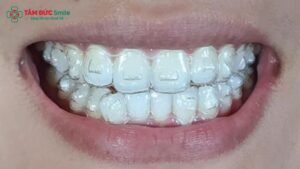 attachment-invisalign-1