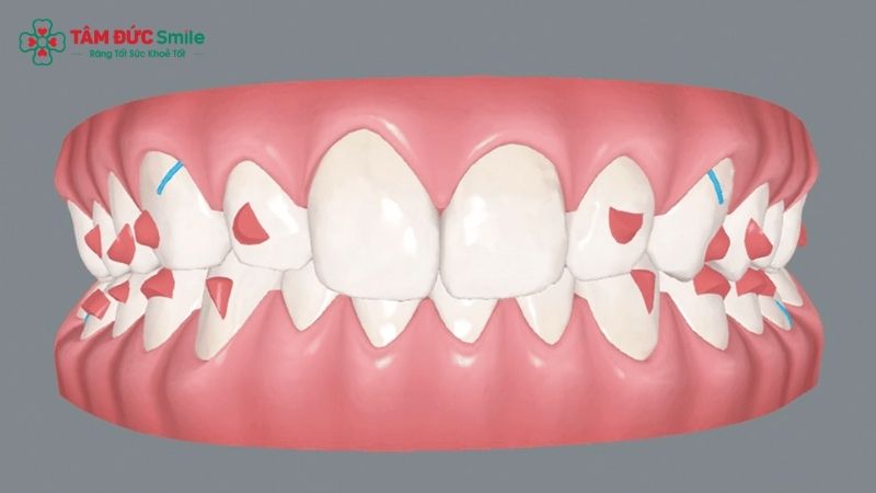 attachment-invisalign-2