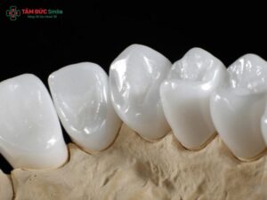 rang-su-emax-gia-bao-nhieu-1