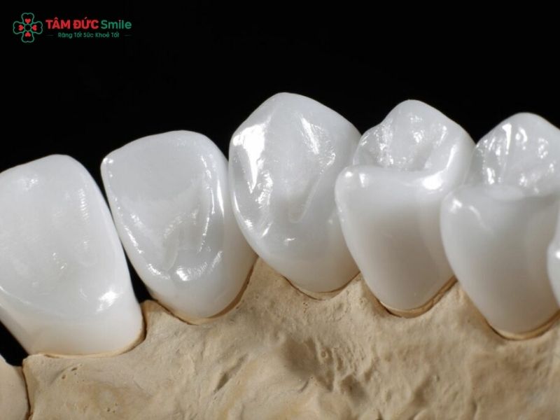 rang-su-emax-gia-bao-nhieu-1