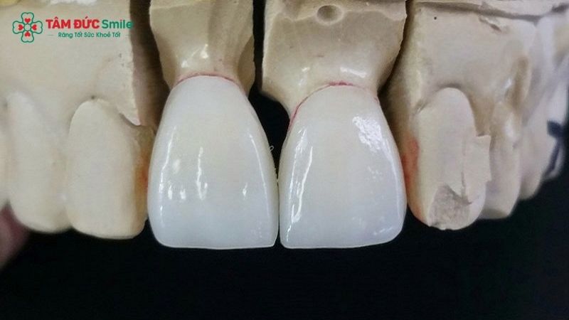 rang-su-emax-gia-bao-nhieu-2