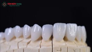 rang-su-ht-smile-gia-bao-nhieu-1