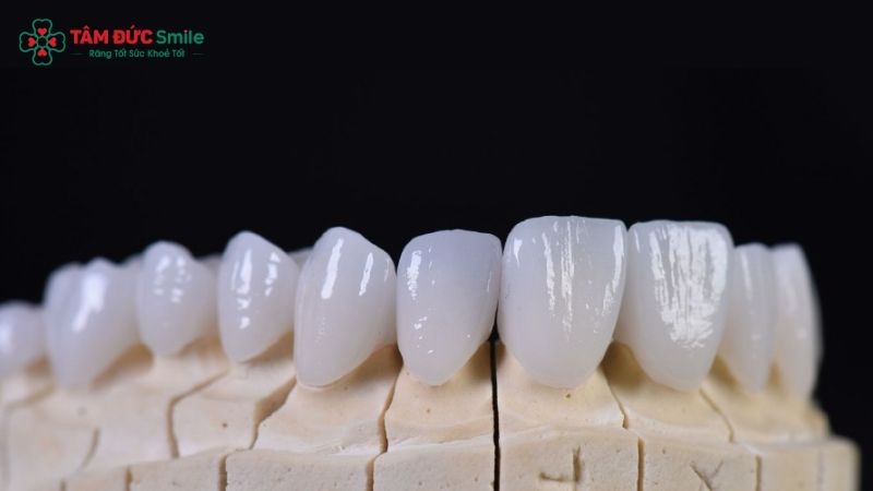 rang-su-ht-smile-gia-bao-nhieu-1