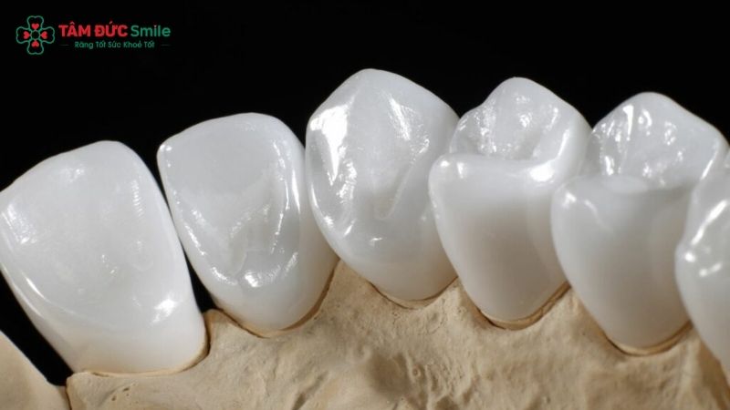 rang-su-ht-smile-gia-bao-nhieu-2