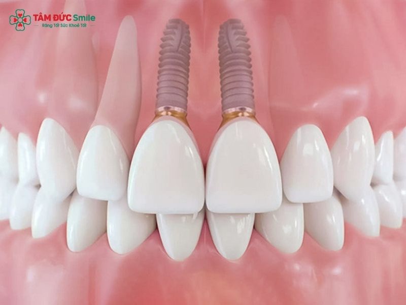 trong-2-rang-cua-gia-bao-nhieu-1