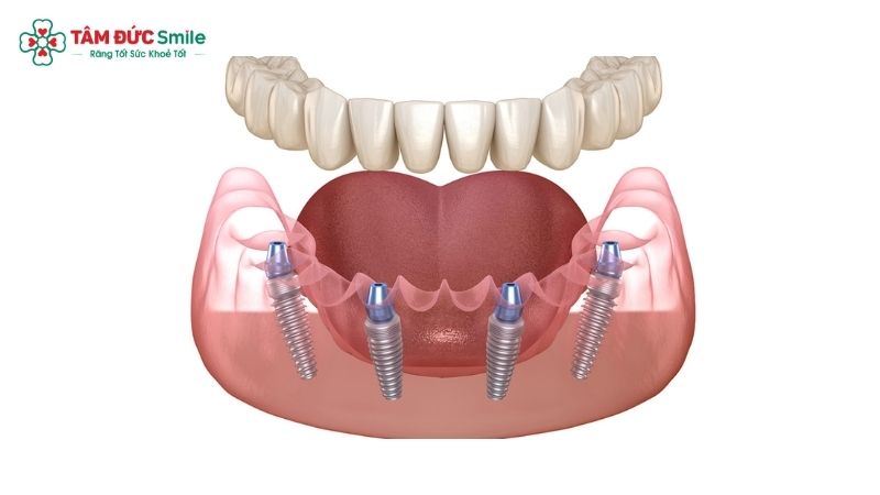 trong-rang-implant-toan-ham-gia-bao-nhieu-1