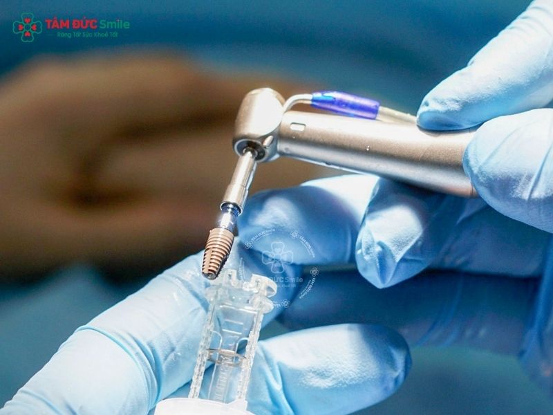 trong-rang-implant-toan-ham-gia-bao-nhieu-3