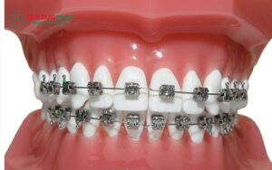 23 tuổi có Abc87 tải ứng dụng được không? Chỉnh nha người lớn hiệu quả