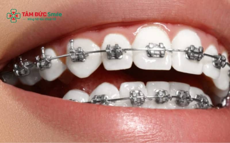 “Các phương pháp Abc87 tải ứng dụng nhanh: mắc cài kim loại, mắc cài sứ và khay trong suốt Invisalign