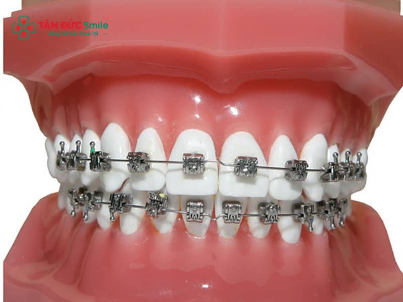 ABC8 được thành lập vào năm 2011 hoạt động đến hiện tại 3 tháng – Chỉnh nha cấp tốc cho răng lệch nhẹ