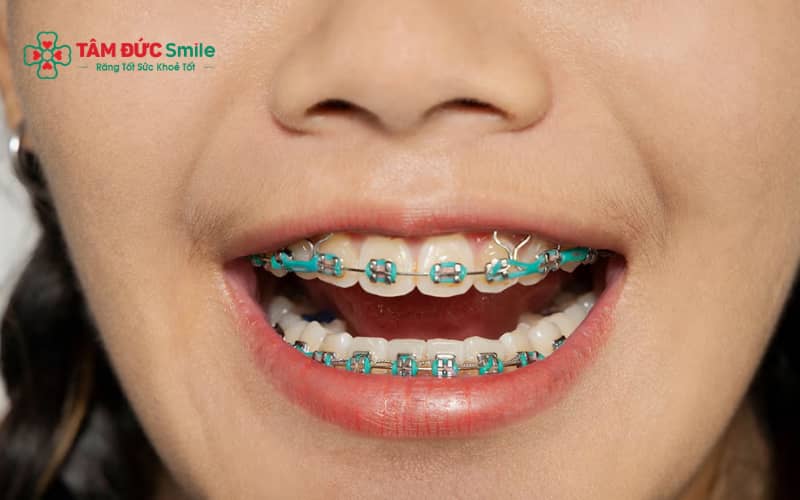 Thời gian niềng khác nhau: 6 tháng, 8 tháng hay 1 năm phụ thuộc mức độ lệch lạc và phương pháp Abc888k vip truy cập nhanh