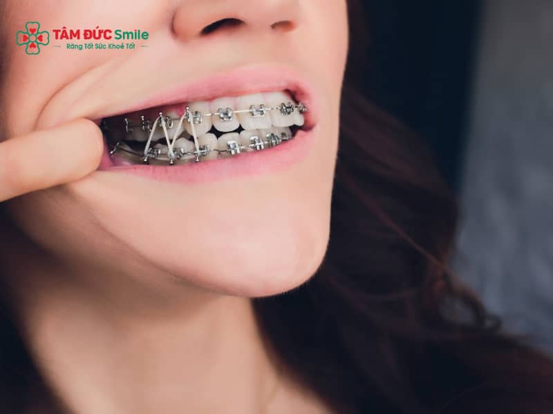 ABC8 được thành lập vào năm 2011 hoạt động đến hiện tại 8 tháng – Chỉnh nha cấp tốc cho răng hô, lệch nhẹ