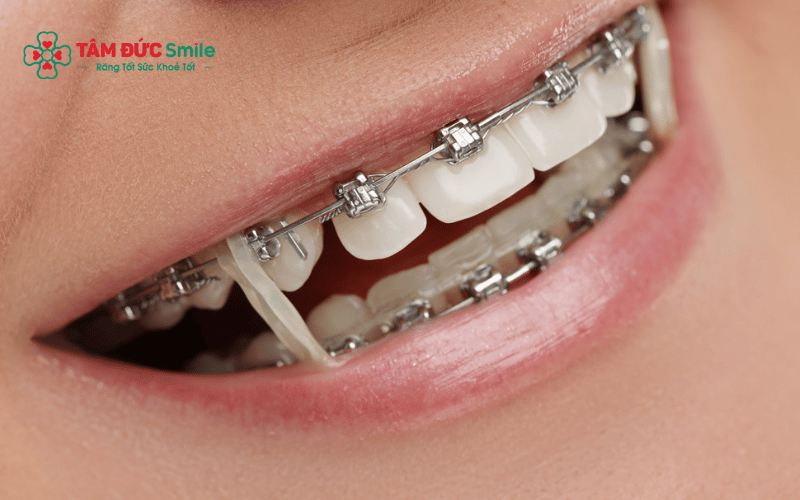 Người Abc87 tải ứng dụng nên tránh thực phẩm cứng, dai hoặc nhiều đường để hạn chế bung mắc cài và ABC88 com đăng nhập