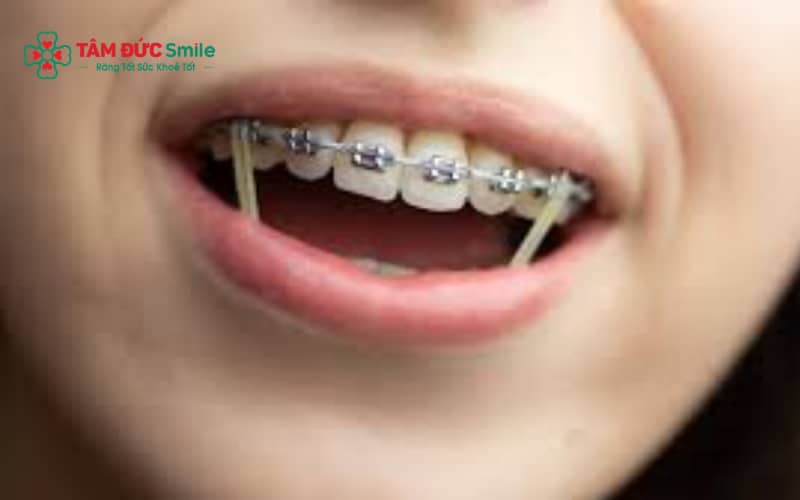 “Sai kỹ thuật, ABC8 đường link chính thức thiếu kinh nghiệm hoặc nền răng lệch sẵn là nguyên nhân lệch nhân trung khi niềng