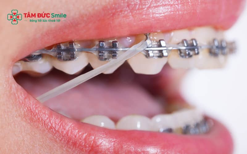 Nhân trung lệch, khớp cắn trái phải không cân đối và răng cửa lệch trục là dấu hiệu điển hình