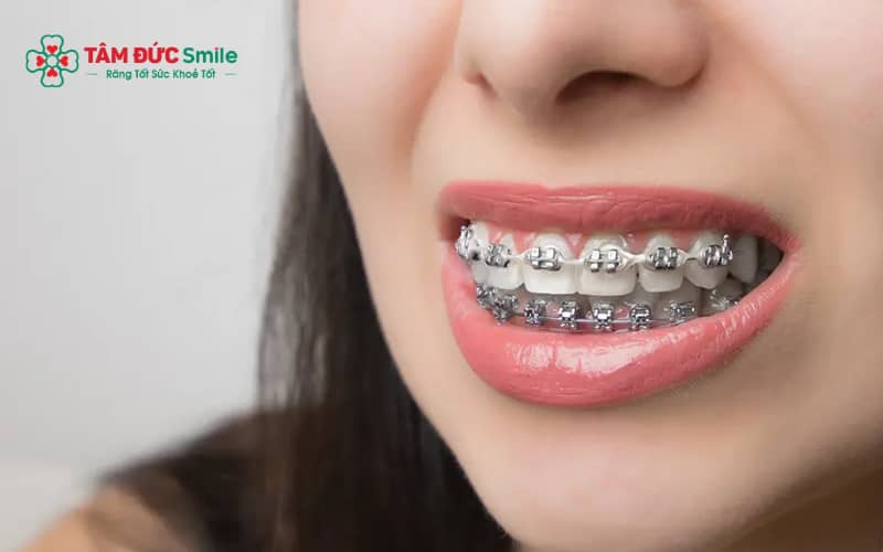 Khí cụ Abc888k vip truy cập nhanh, lực siết và vị trí răng mới là nguyên nhân thay đổi phát âm khi niềng