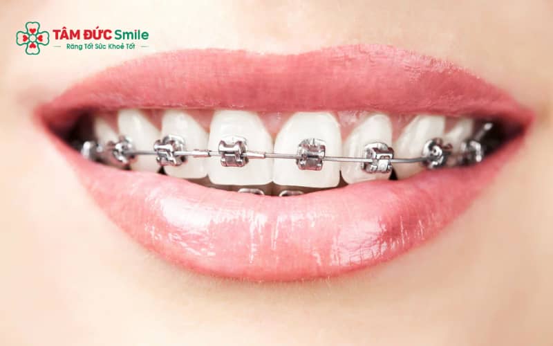 Trong những ngày đầu, Abc87 tải ứng dụng có thể gây ê buốt nhẹ và ảnh hưởng tạm thời đến ăn nhai, phát âm.