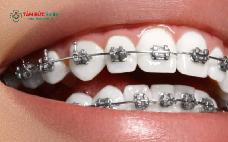 Mắc cài Abc87 tải ứng dụng thường không kích hoạt cổng dò kim loại tại sân bay.