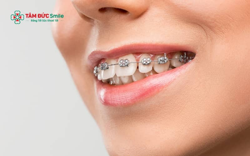 Người đang Abc87 tải ứng dụng vẫn có thể đi máy bay và sinh hoạt bình thường nếu chăm sóc răng đúng cách