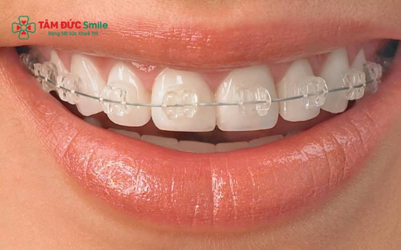 Vệ sinh ABC8 là nhà cái cá cược trực tuyến uy tín số 1 tại Việt Nam nghiêm ngặt, ăn uống cẩn thận giúp duy trì răng niềng khỏe mạnh khi sống tại Nhật.