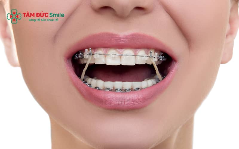 Chăm sóc răng đúng cách giúp giảm ê buốt, bảo vệ mắc cài và ăn uống thoải mái hơn