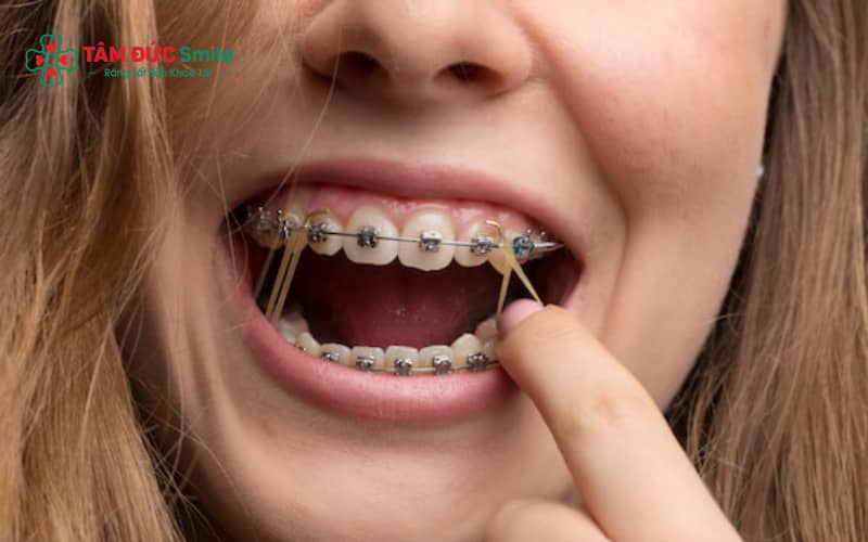 Sau giai đoạn siết răng và ổn định khớp cắn, bệnh nhân có thể ăn uống gần như bình thường