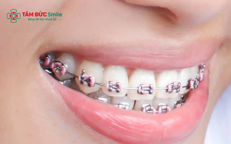 “Nụ cười đẹp, răng đều và sạch là tiêu chuẩn quan trọng trong các cuộc thi sắc đẹp hiện nay